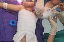 Bé 3 tuổi ngã vào nồi nước nóng bỏng khắp cơ thể