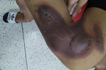 Nhiều trẻ bị tổn thương bàn tay nặng do pháo tự chế