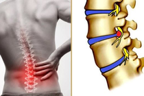 Đau dây thần kinh tọa vì thoái hóa đốt sống lưng phải làm sao?