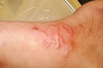 Lấy xong ổ giun lươn đã hết bệnh?