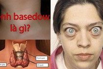 Bệnh Basedow giảm bạch cầu có nên điều trị?
