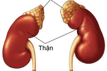 Suy tuyến thượng thận vì lạm dụng corticoid