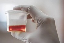 Tiểu ra máu sau quan hệ tình dục 