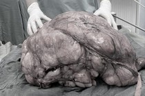 Người đàn ông mang “bụng bầu” u mỡ nặng gần 18kg