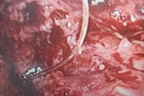 Cụ ông nguy kịch vì xương cá xuyên thủng đại tràng