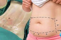 Tạo hình thành bụng có cần giảm cân?