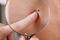 U hắc tố trẻ em 