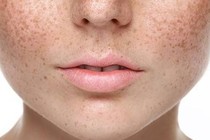 Tại sao da vẫn bị sạm nám dù không tiếp xúc ánh nắng?