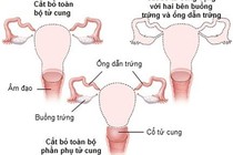 Cắt tử cung có ảnh hưởng chuyện phòng the?