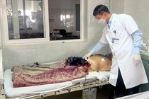 Người đàn ông tự cắt lìa dương vật vì đi tiểu khó khăn