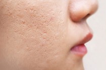 “Điểm mặt” những cách chăm sóc da sai cách khiến lỗ chân lông ngày càng to