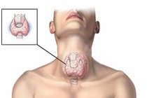 Đi khám viêm họng bất ngờ phát hiện ung thư tuyến giáp