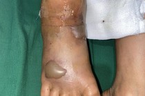 Bị rắn độc cắn, bé trai bị rối loạn đông máu, bàn chân tổn thương nặng