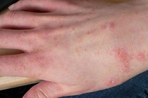 "Điểm mặt" 5 bệnh về da dễ gặp vào mùa mưa
