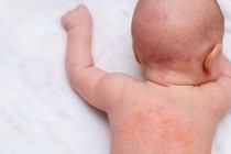 Mách mẹ 5 loại nước tắm trị rôm sảy cho trẻ trong mùa hè