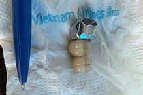Nuốt cả cầu răng giả khi ăn phở, dị vật thế nào là nguy hiểm?