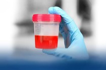 Đi tiểu ra máu, bé trai 7 tuổi mắc... viêm cầu thận cấp