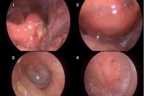 Tự lấy xương cá bị hóc, người đàn ông phù nề hạ họng, thanh quản