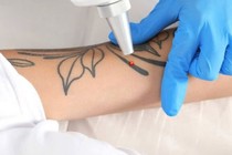 Nhiễm trùng huyết, tổn thương cơ tim do xóa xăm tại cơ sở không phép