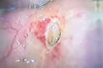 Đau bụng, buồn nôn, đi khám phát hiện thủng tạng rỗng do viêm loét dạ dày