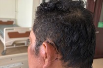 Thận trọng với biến chứng của viêm tai xương chũm mãn tính 