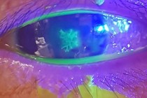 Đau mắt, nhìn mờ, nhỏ thuốc không đỡ, đi khám mắc viêm giác mạc do Herpes