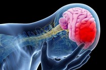 Méo miệng, nói khó... đi khám được chẩn đoán nhồi máu não