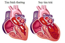 Suy tim trái là gì và cần được điều trị ra sao?