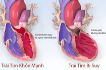 Hiểu về suy tim trái và suy tim phải để có cách chữa hiệu quả