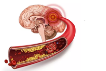 Dọn sạch máu đông trong não để nói không với đột quỵ