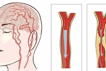 Bệnh nhân U50 nhồi máu não qua đời: Bác sĩ khuyến cáo gì?