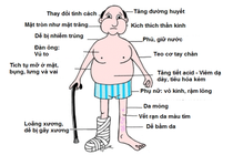 Nhiều người mắc hội chứng Cushing do lạm dụng thuốc corticoid