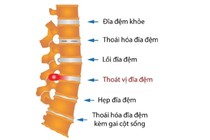 Bác sĩ chỉ rõ các triệu chứng bệnh thoái hóa đĩa đệm cột sống thắt lưng