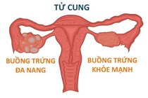 buồng trứng đa nang