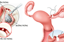 Dấu hiệu nhận biết vô sinh nữ