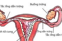 Tắc vòi trứng