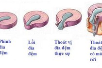 Can thiệp sóng cao tần trị thoát vị đĩa đệm