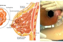 Biến chứng nguy hiểm của áp xe vú chị em cần biết