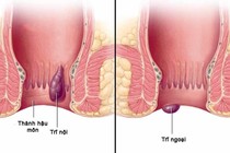 Trĩ để lâu gây biến chứng nguy hiểm gì?