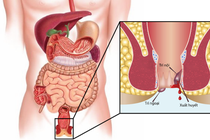 Điều trị trĩ không đúng cách bệnh nhân phải truyền 3,25 lít máu