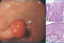 Polyp u tuyến dạ dày có ung thư?