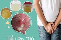 Đái buốt ra mủ là bệnh gì?