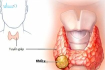 Người có bướu nhân có dễ bị ung thư tuyến giáp không?