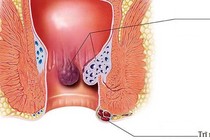 Biết sai lầm mà tránh khi bị bệnh trĩ