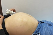 U nhầy buồng trứng nặng 8 kg