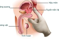 Bác sĩ chỉ rõ dấu hiệu phát hiện sớm ung thư tiền liệt tuyến