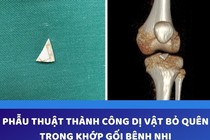 Hy hữu: Mảnh sành sắc nhọn bị "bỏ quên" 2 năm trong khớp gối