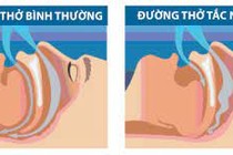 Hỏng mắt vì chứng ngưng thở khi ngủ