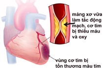 Bác sĩ mách cách xử lý khi có dấu hiệu nhồi máu cơ tim