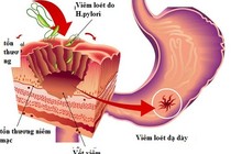 Chuyên gia mách cách phòng ngừa viêm loét dạ dày, tá tràng?